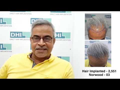 Ravi Shares His Feedback Regarding DHI Technique- Global Leader in  Hair Transplant