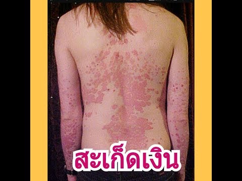 กลากสุนัขซื้อในมอสโก มันเป็นไปได้ที่จะทำงานเป็นครูกับโรคสะเก็ดเงิน