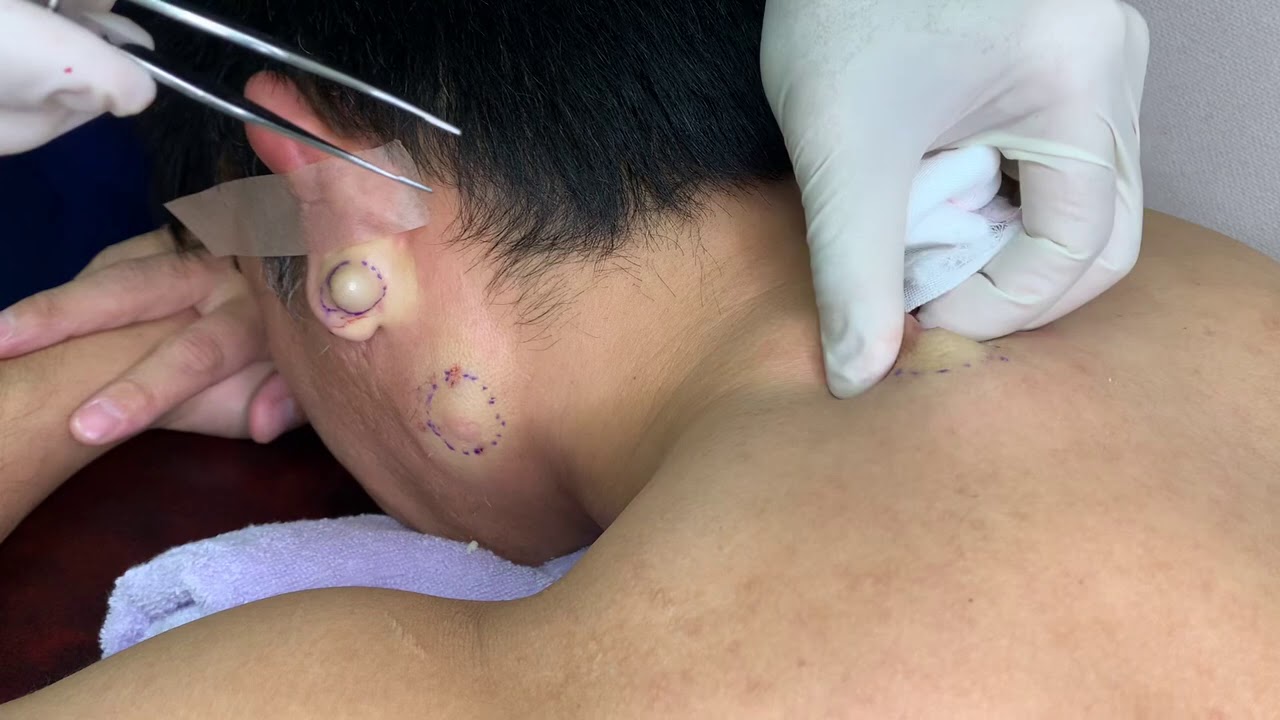 粉瘤くりぬき法　30代男性背中epidermal cyst atheroma cystic acne extractions lipoma大阪心斎橋　大阪梅田院　名古屋　福岡院　神戸西宮　尼崎　奈良