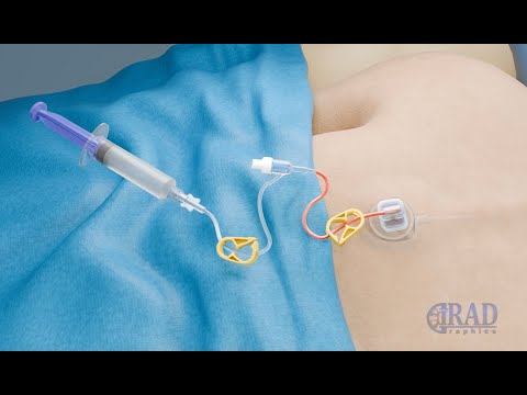 Chest Port Placement