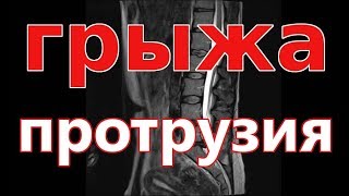 Грыжа позвоночника и протрузия - это выпячивание межпозвоночного диска между позвонками, которое приводит к болезненным состояниям. 
Протрузия - это начальная стадия грыжи, когда межпозвоночный диск выпячивается в сторону между