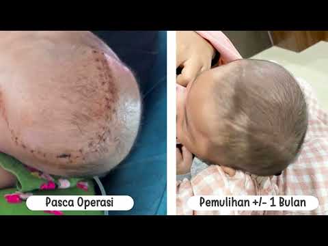 Tahukah Stella Family apa itu VKDB (Vitamin K Deficiency Bleeding) ?