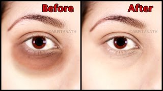 Get Rid of Under Eye Dark Circle, Puffiness, Fine Lines in 1 Week || Magical Eye Mask
