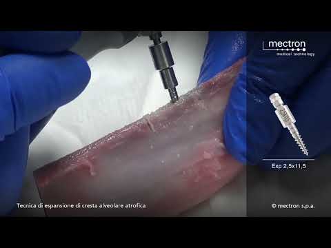 how to use Ridge Expansion technique using PIEZOSURGERY®