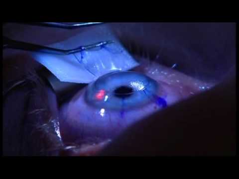 Laser Eye Surgery | The Patient Experience at London Vision Clinic on Harley St. London