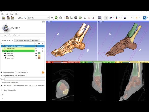 Feet segmentation in 3D Slicer