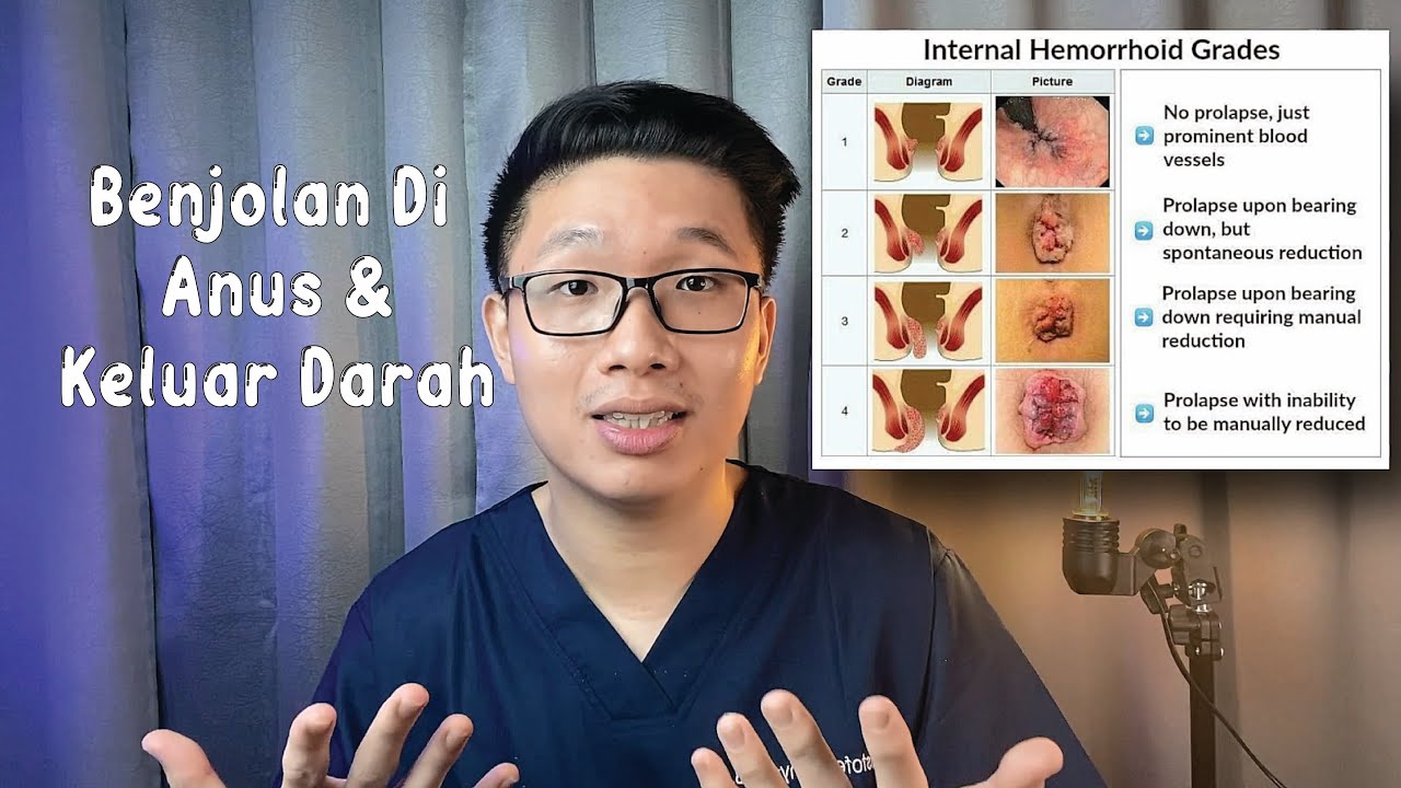 Putar video Benjolan Di Anus Dan Keluar Darahnya Bahayakah | Kenali Hemoroid Dari Sekarang sekarang Benjolan Di Anus Dan Keluar Darahnya Bahayakah | Kenali Hemoroid Dari Sekarang