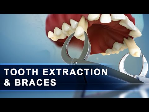 EXTRACTION AND BRACES