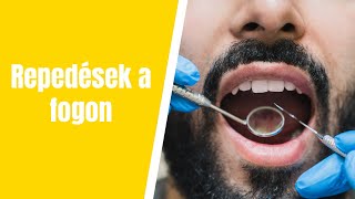 Repedések a fogon?