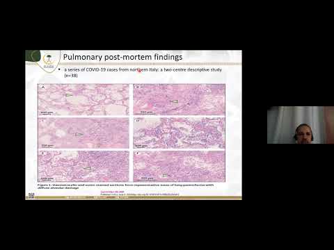 Hematological complications of COVID-19 infection: Mohammed Alsheef-  09 Oct 2021