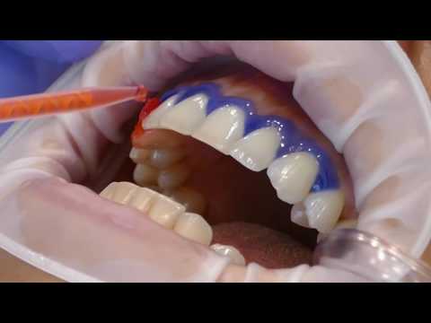 PROF. GEORGI TOMOV - wybielanie zębów laserem LITEMEDICS - BTL Polska