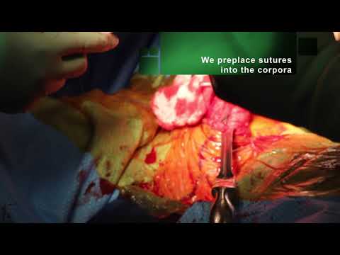 Plastyka skrzywienia prącia oraz wszczepienie protezy prącia 