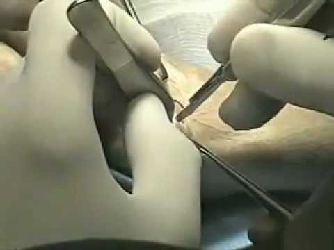 Prosthetic Arthroplasty of the Thumb CMC Joint 