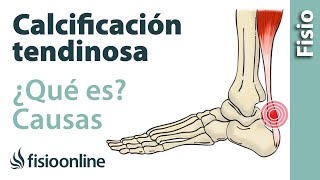 Calcificación tendinosa - Qué es y cuáles son sus causas