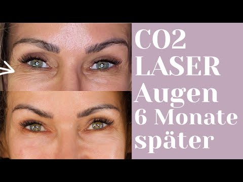 CO2 Laser nach 6 Monaten – Hat es sich gelohnt ?