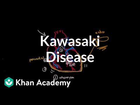 Kawasaki disease: diagnosis and treatment | Circulatory System and Disease | NCLEX-RN | Khan Academy