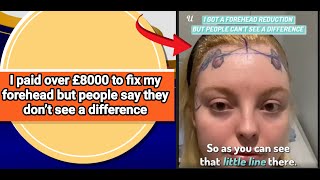 I paid over £8000 to fix my forehead but people say they don’t see a difference