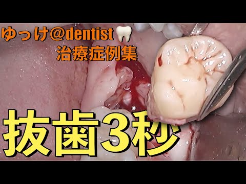 生命歯学科 【閲覧注意】埋伏した親知らず抜歯　痛み腫れなし！早技３秒！　ノーカットで全部お見せします！