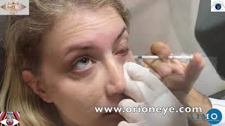 Occhio secco da disfunzione delle ghiandole del Meibomio