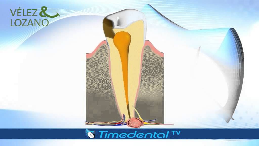 ¿Qué son y cómo tratar los quistes dentales - Dentistas Murcia