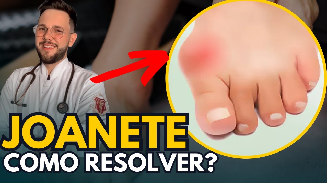 HOW TO TREAT A BUNION AT HOME WITH ONLY 3 EXERCISES