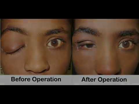 Surgical Management Of Neurofibromatosis Of Eyelid