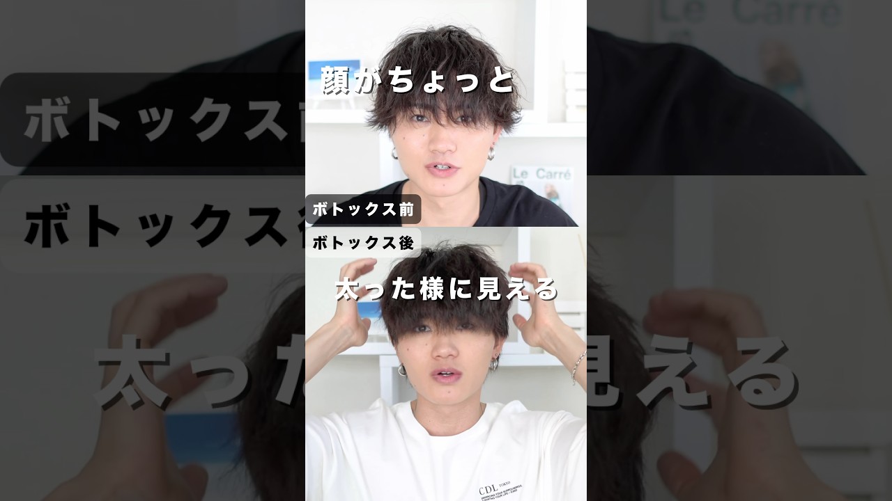 #エラボトックス 注射を半年辞めてみた結果… #ボトックス注射