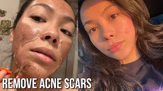 First Chemical Peel Experience! | Results Before & After