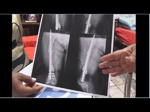 Idosa se queixa de sequelas de cirurgia na perna
