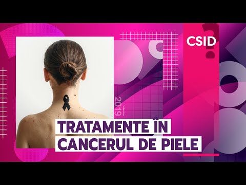 Cancer de piele (melanom malign, alunite cancerigene): tratamente explicate de Dr. Mihaela Leventer