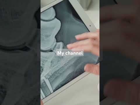Why Navicular Disease Is Not A Death Sentence