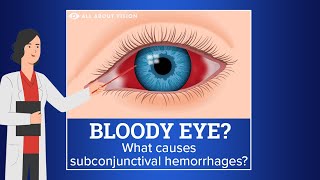 Subconjunctival Hemorrhage (Blood in Eye)