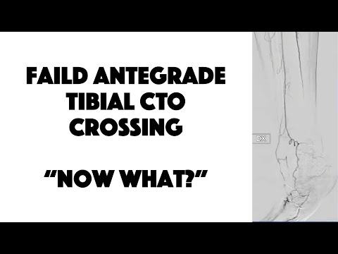 Failed Antegrade Tibial CTO Crossing: Now what?
