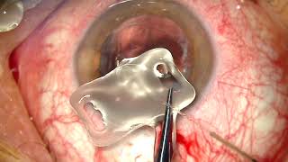 Recambio de lente intraocular en saco 7 años después de la cirugía inicial. Bonafonte