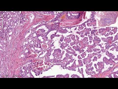 Neuroendocrine cancer with liver metastases