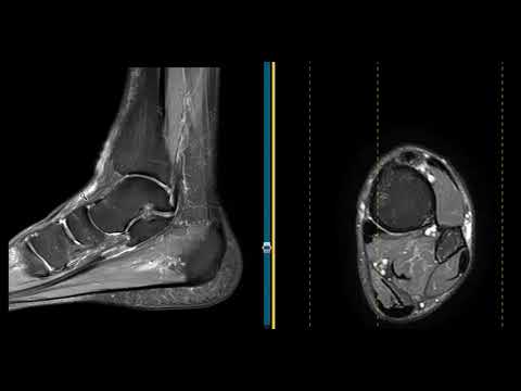 Torn anterior tibial tendon