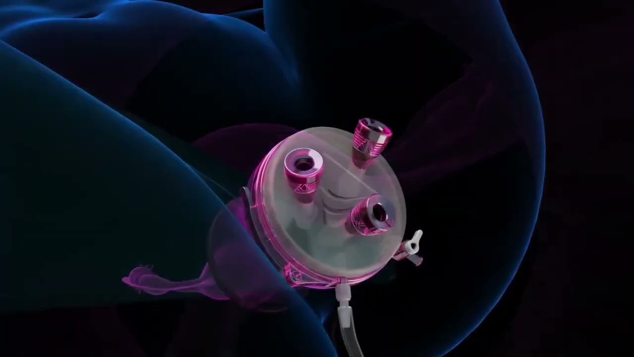 vNOTES (Vaginal Natural Orifice Transluminal Endoscopic Surgery) Hysterectomy