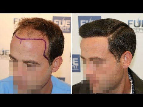 FUE Hair Transplant (3958 grafts in NW-Class lV-A),  Dr. Juan Couto - FUEXPERT CLINIC