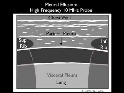 Ultrasound Guidance for Thoracentesis - Sonosite