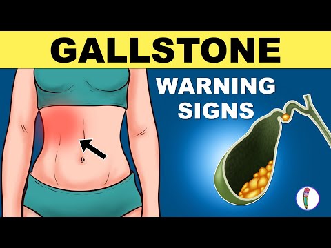 Gallbladder Stones Symptoms | Cholelithiasis | Gallstones Symptoms | Gallstones Warning Signs