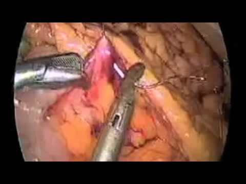 Laparoscopic Repair Of Large  Incarcerated Traumatic Diaphragmatic Hernia