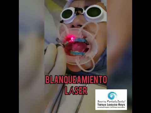 Blanqueamiento dental láser por la Tarsys Loayza Roys en Cartagena