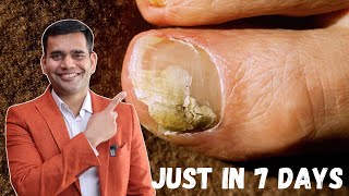 Just in 7 Days Cure Toenail Fungus At Home | Best Remedy For Toenail Fungus - Dr. Vivek Joshi