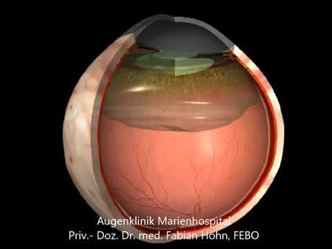 Krankheiten des Auges: Hintere Glaskörperabhebung