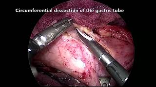 Asvide: The video demonstrates careful dissection around the gastric tube, highlighting the use...