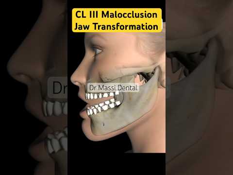Malocclusion, CL II , CL III  Braces Orthodontics jaw transformation