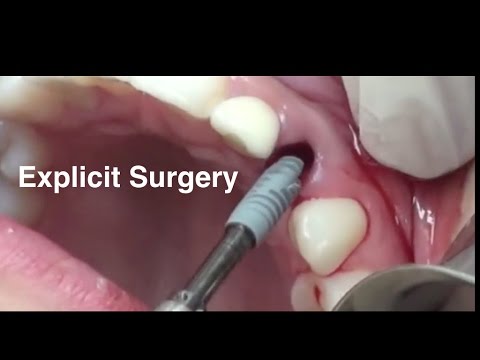 Immediate Dental Implants - Papilla Reconstruction