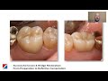 Successful Crown Bridge Restoration From Preparation To Definitive Cementation