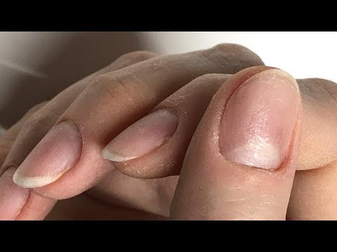 Ihtiolovye kaufen Kerzen in der Prostata Sarkom mit Prostata