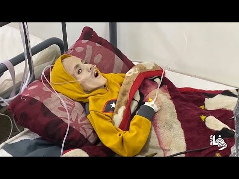 شاهد تحول إلى هيكل عظمي.. مقتل 15 طفلا فلسطينيا بسبب الجوع والجفاف من بينهم يزن الكفارنة
